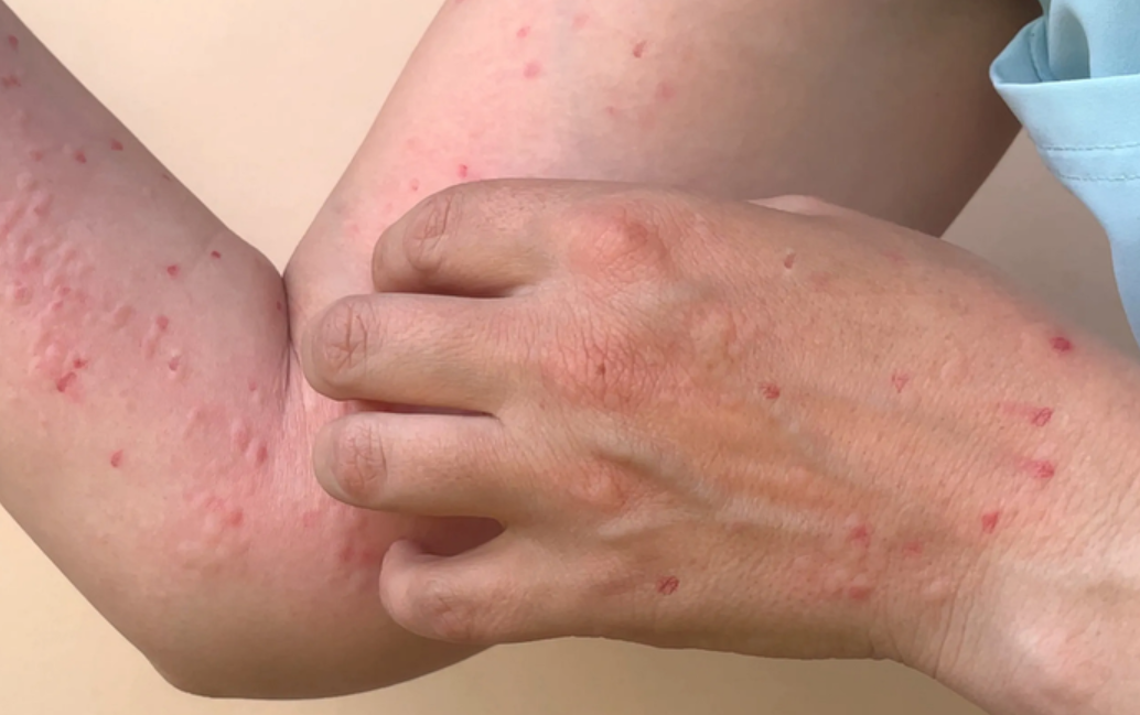 Đồng Nai: Ghi nhận một bệnh nhân mắc đậu mùa khỉ